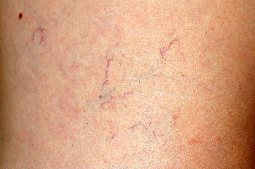 prevent-spider-veins-prevent-varicose-veins-robelyn-labs